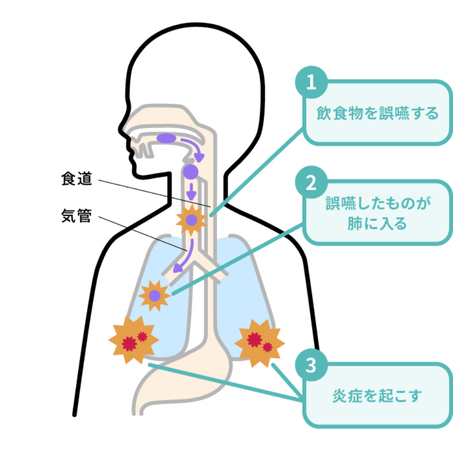 誤嚥により細菌が肺に入り込む