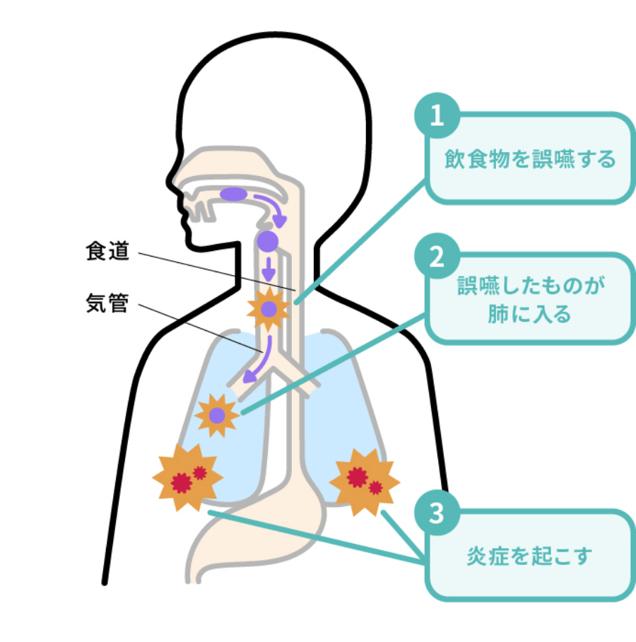 誤嚥により細菌が肺に入り込む