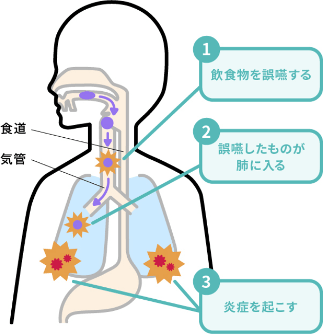 誤嚥により細菌が肺に入り込む