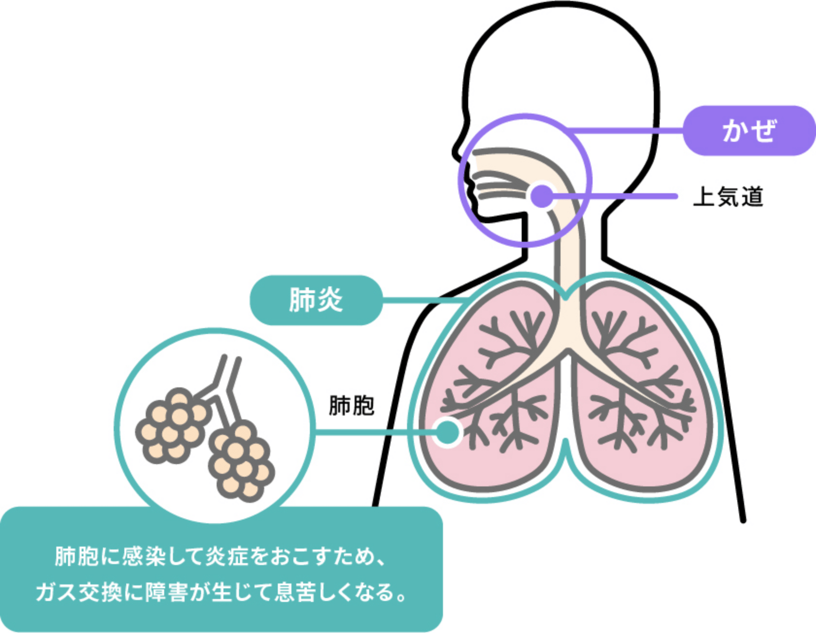 かぜと肺炎は、ちがいます