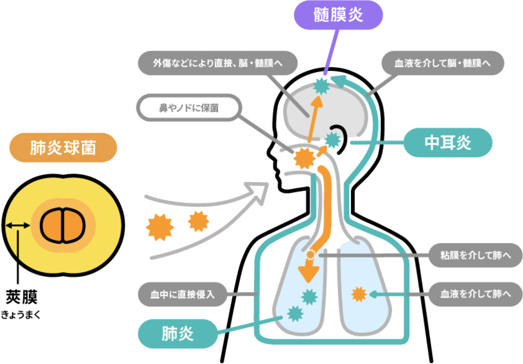 肺炎球菌は、脳や髄膜に入り込むと「髄膜炎」を、耳に入って感染すると「中耳炎」を発症